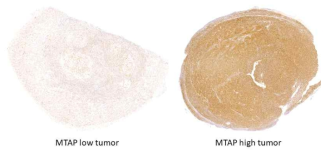 PDX 종양 조직에서 MTAP 의 발현양상 분석