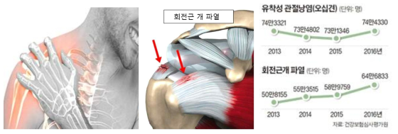 어깨 통증과 회전근 개 파열