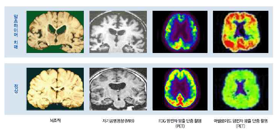 알츠하이머 치매 뇌 영상 소견 (보건복지부)