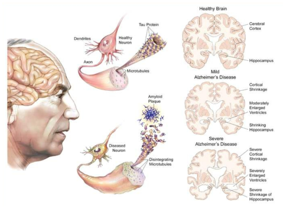 알츠하이머 질환에 의한 뇌신경세포 퇴화 및 대뇌피질과 해마 조직의 감소 (THE UNIVERSITY of NORTH CAROLINA)