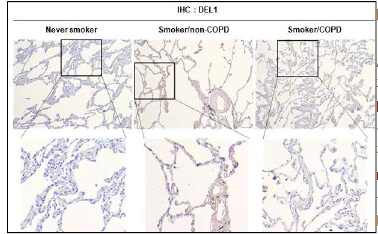 흡연자/non-COPD 환자 폐조직에서 DEL1 발현증가. 정상인, 흡연자/non-COPD, 흡연자 /COPD 환자의 폐조직에서 DEL1에 대한 면역조직 화학염색 (IHC) 수행. 폐조직을 4% paraformalde hyde 용액에 고정. 파라핀 포매/조직 절편을 만들어 슬라이드 위에 부착, 조직절편의 탈파라핀, 수화과 정 수행. Cell conditioning 1 standard를 antigen retrieval (항원회복)에 사용. 1차 항체를 24시간 반 응시키고, 2차 항체를 37도에서 20분 부착. DAB H2O2를 37도에서 8분 반응시킴