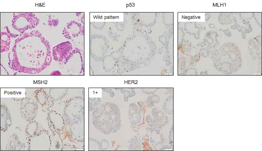 면역조직화학 염색을 통한 hMLH1 loss 패턴 확인을 통한 장형-MSI-H 타입 위암 오가노이드 확인 예 (YPGC-054)
