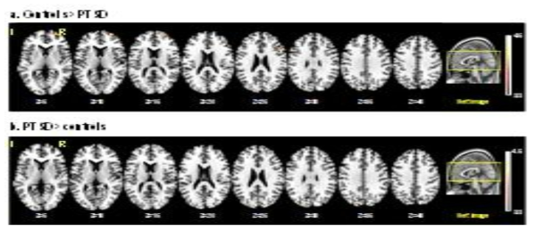 Brain areas predominantly activated in healthy controls vs. patients with PTSD during WM maintenance of the target faces with anxiety-provoking pictures, which were analyzed with pos-hoc t-test (p<0.005)