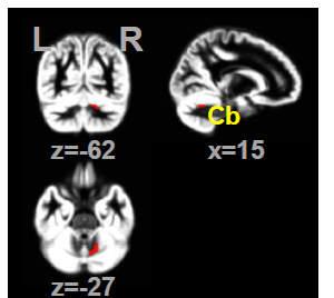 Increased gray matter volumes in patients with Posttraumatic Stress Disorder (PTSD) compared to healthy controls. L, left; R, right; Cb, cerebellum