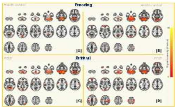 Positive connectivity networks associated with Cb(cerebellum) showing the in GM volume increase in PTSD patients during encoding (A) (B) and retrieval periods (C) (D) (one sample t-test, voxel threshold: uncorr. P < 0.001, cluster threshold: p-FDR < 0.05)