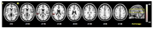 Brain areas predominantly activated in patients with PTSD over healthy controls during WM maintenance of the target faces with anxiety-provoking pictures over neutral scene distractor (p<0.001)