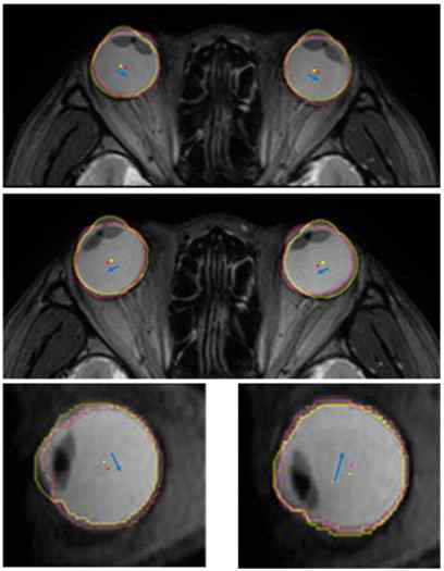 MRI 영상에서 확인되는 안구의 전이운동