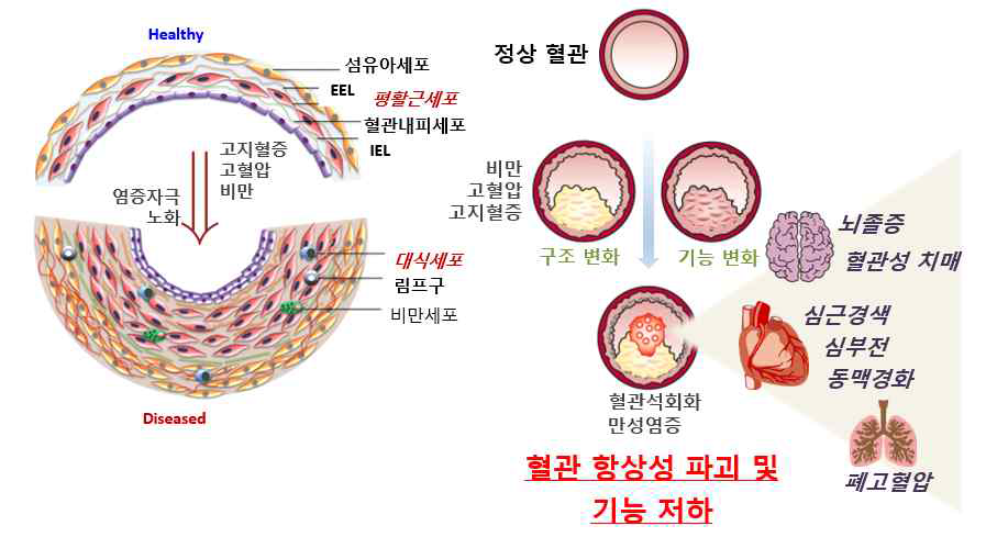 혈관리모델링 정의와 연구의 필요성의 도해