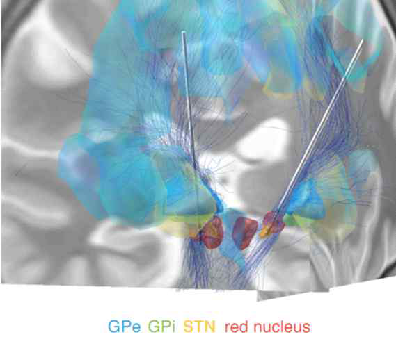 확산텐서영상(Diffusion tensor imgaing, DTI)와 함께 시각화한 전극 위치