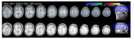 수술 전후의 T1 MR volumetry: 전체 뇌 부피 중 백질의 비율은 같은 정도로 유지되었으나 회백질의 비율은 감소하였음
