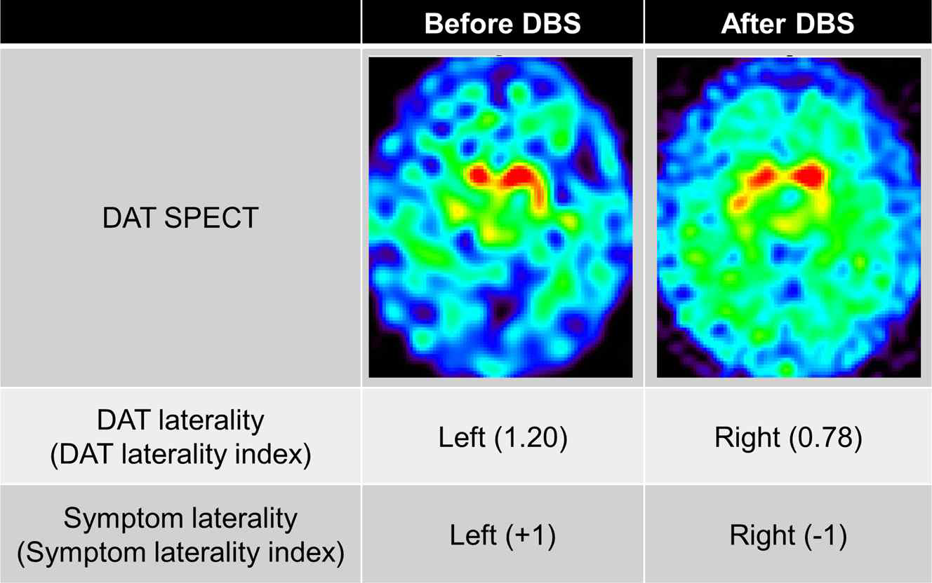 기준 시점에서 좌측 우세 증상을 보인 환자 1명은 DBS 이후 우측 우세증상을 보임