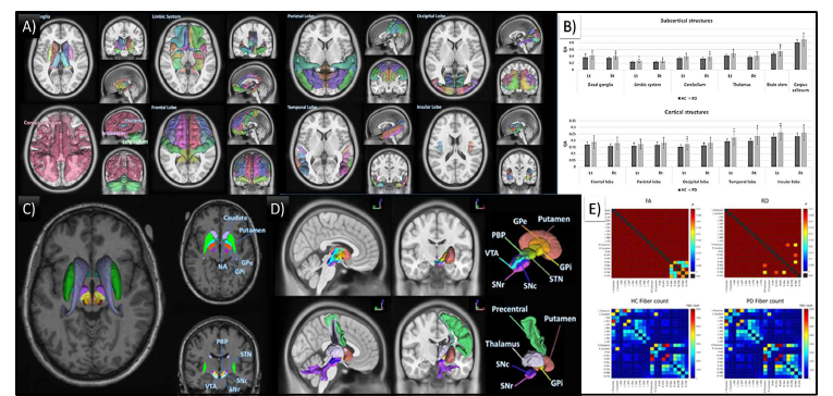 파킨슨병 환자와 건강한 대조군 피질, 기저핵 구조 및 기저핵 간 연결성의 확산 측정 비교 결과 A) 뇌 영역으로 구성된 140개의 분할된 피질 및 피질 하부 구조. B) 차트는 파킨슨병 환자와 건강한 대조군 사이의 피질 및 피질하 구조 모두의 상당한 QA 차이를 보여줌. C) 연결성 연구에 사용되는 분할된 기저핵 구조. D) 기저핵 간 백질 tractography의 3D 표현 E) PD와 HC 기 저핵 연결성 간의 상당한 확산 측정 차이(FA, RD)의 매트릭스
