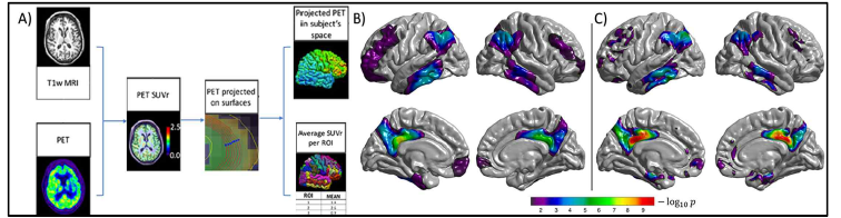 동일한 파킨슨 환자에서 얻은 T1w MRI와 저해상도 PET 영상을 결합해서 환자 뇌 표면과 피잘하 공간에 PET 신호를 고해상도로 투영하는 과정 (A) T1w MRI과 PET 영상 데이터 처리 과정, (B) 유의한 PET 신호 차이를 보이는 뇌 표면 영역, (C) 유의한 PET 신호 차이를 보이는 피질하 영역