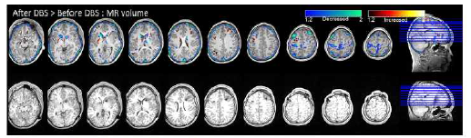 수술 전후의 T1 MR volumetry: 전체 뇌 부피 중 백질의 비율 은 같은 정도로 유지되었으나 회백질의 비율은 감소하였음