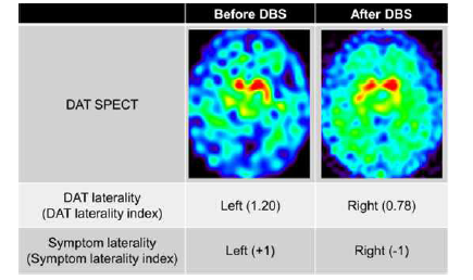 수술 전 및 수술 후 123I FP-CIT SPECT 섭취 정도의 변화가 실제 임상 증상 편측성의 변화와 일치하였음