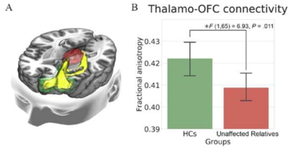 시상-안구전두엽 사이의 연결성이 조현병 유전고위험군에서 정상인에 비해 유의하게 낮아져 있음을 증명하였음