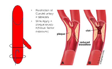 Schematic diagram of carotid stenosis and carotid injury animal model