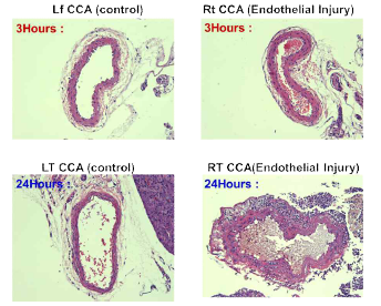 Histological staining of the carotid artery with (right) and without (left) stenosis