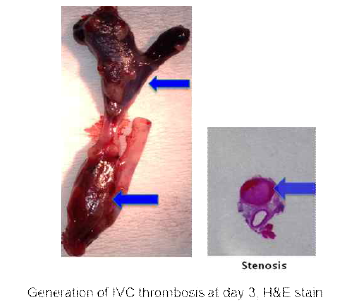 Pathologic specimen of IVC and histologic stain of the IVC after the stenosis