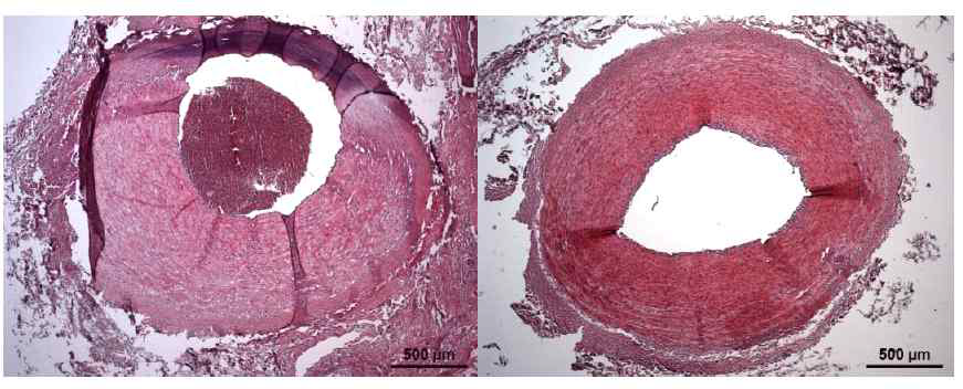 혈전 유발 경동맥의 조직검사 영상 (왼쪽 : 혈전 유발 부분, 오른쪽 : 대조군)