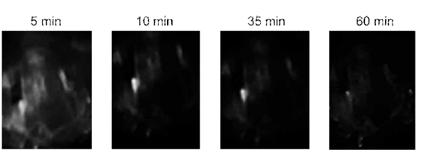 Imaging of carotid stenosis using thrombus targeted bio-imaging agents