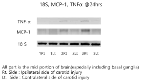 Expression of Inflammation Markers after Right Carotid Artery Injury in Brain