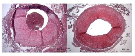 혈전 유발 경동맥의 조직검사 영상 (왼쪽 : 혈전 유발 부분, 오른쪽 : 대조군)