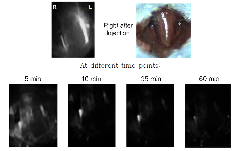 Imaging of carotid stenosis using thrombus targeted bio-imaging agents