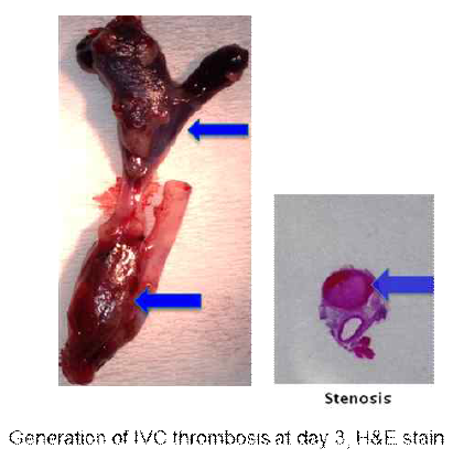 Pathologic specimen of IVC and histologic stain of the IVC after the stenosis