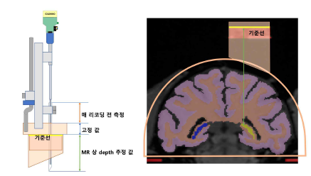 1채널 전극 시스템으로 해마를 리코딩하는 계획도. 두개골에 이식된 리코딩 챔버 위로 그리드를 장착하고 그리드 위에 전극 시스템을 고정하여 전극을 내림