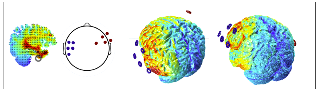 (좌) 시뮬레이션을 통해 원하는 타겟에 최적화된 두 개의 4x1 전극배치를 도출 (우)실제 연구참 가자의 T1이미지를 이용한 계산 결과