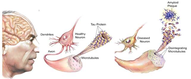 타우의 NFT와 타우-마이크로튜불의 안정성이 알츠하이머병에 미치는 영향. (출처: NIH Progress Report on Alzheimer’s)