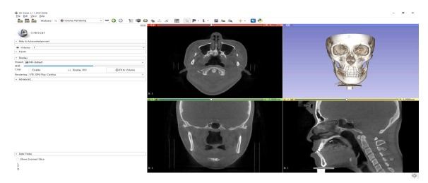 Volume Rendering을 통한 3D 모델 구현