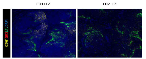 재조합 GLA (FZ)을 처리하여 분화시킨 파브리병 신장 오가노이드에서의 세뇨관(LTL)과 집합관(CDH1) 마커 및 Gb3 염색