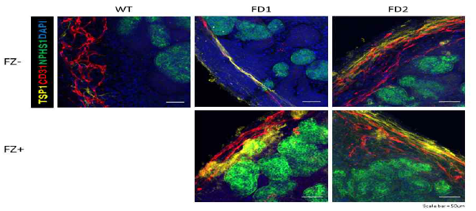 FZ를 처리 후 분화한 파브리병 신장 오가노이드에서 TSP1과 CD31의 발현