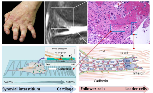 류마티스 관절염에서 활막세포의 연골 침습 과정