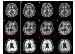 The input and output of PET images (upper row, BAPL 1; middle row, BAPL 2; lower row, BAPL 3). PET 2m image (input image) is very noisy and the image quality is poor (a,e,i). The ground truth with 20-min scanning (b,f,j) and synthetic PET images generated from the proposed deep learning (c,g,k) and the U-net (d,h,l) are shown. The synthetic PET image generated from our model is better in reflecting the underlying anatomical details than is the PET image generated from the U-net. In the BAPL 2 case, a small positive lesion (red arrows, e–h) is equivocal in the PET 2m image (e), but clearly shown in sPET 20m image (g) as in PET 20m image (f)