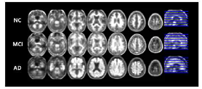 Multi-slices of pre-processed 18F-Florbetaben imaging by disease group. Each column shows 7 axial planes observed at equal intervals, and a sagittal plane. The blue lines represent the extracted level of each axial plane