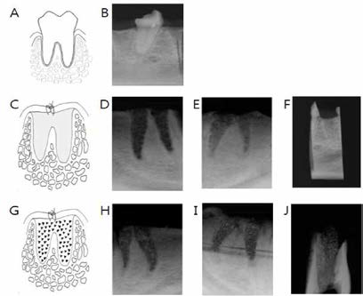 발치와 처리에 따른 시간별 골형성 모식도와 X-ray 사진. A B， 발치 전. C-D . 대조군 발치 후 1주， E -F . 대조군의 발치 후 2, 4주，G-H . 발치후 합성골 처리 후 1주，I-J . 발치 후 합성골 처리 후 2, 4주