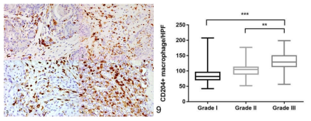 CD204발현 macrophage의 grade별 비교 IHC사진 및 정리 그래프