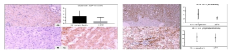 Glypican-3(좌), hTERT(우)의 면역조직화학염색 분석 결과