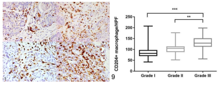 CD204 양성 대식세포의 grade 별 비교 IHC 결과 사진(좌), 비교 그래프(우)