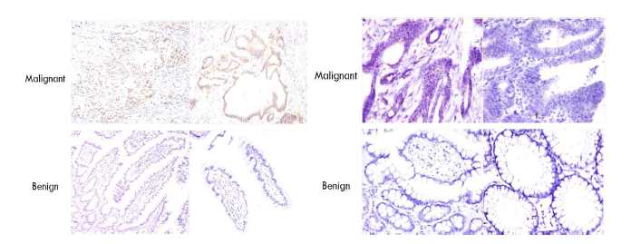 EGFR IHC 실험 사진(좌), RNA-ISH 사진(우)