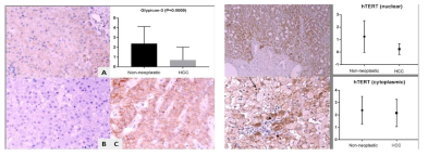 Glypican-3 (좌) hTERT (우)의 면역조직화학염색 분석 결과 사진