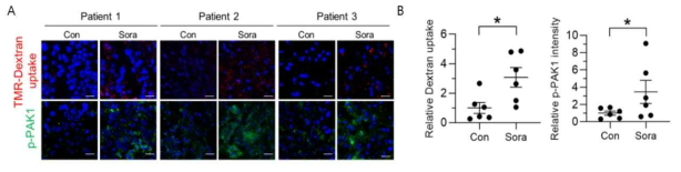 sorafenib에 의해 인체 간암조직에서 macropinocytosis 가 증가함