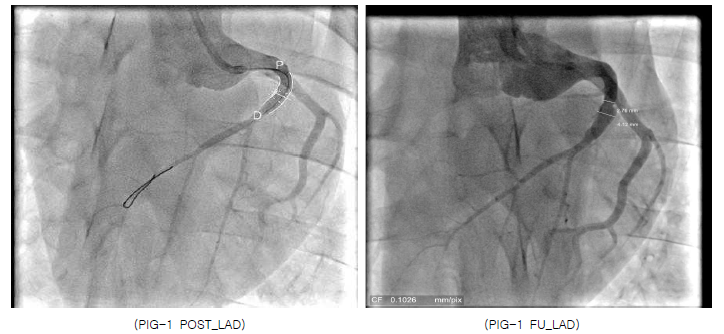 Aneurysm (FU REF. Diameter : 2.76mm / Max Lumen Diameter : 4.12mm)