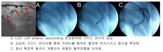 경피적 관상동맥 성형술(PTCA) 시술방법