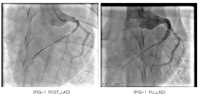 Aneurysm (FU REF. Diameter : 2.76mm / Max Lumen Diameter : 4.12mm)