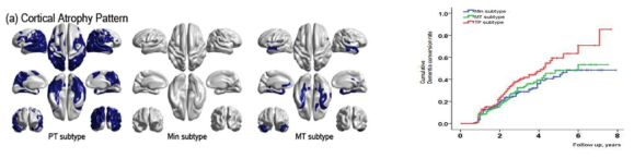 경도인지장애 환자의 3가지 atrophy subtype. Parietotemporal (PT) Atrophy subtype이 가장 나쁜 예후를 보였음