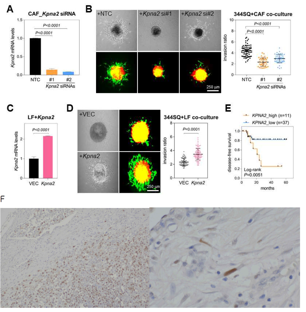 Effects of KPNA2 on CAF activity A. qRT-PCR of Kpna2 in murine CAFs transfected with non-targeting control (NTC) or Kpna2 siRNAs (#1 and #2). Expression levels were normalized to the Rpl32 mRNA level, and values relative to that of NTC (set at 1.0) are presented. P, two-tailed Student’s t test. Mean + SD (n=3). B. Spheroid invasion assay in 344SQ cells co-cultured with CAFs transfected with NTC or Kpna2 siRNAs (si#1 and #2). 344SQ cells were labeled with mCherry (red fluorescence), and CAFs were labeled with GFP (green fluorescence). Spheroids made from hanging-drop cultures were seeded on collagen gels and then cultured for two days. Spheroid invasion ratios (ratio of whole cell area to central spheroid area) were measured using ImageJ. Mean ± SD (+NTC, n=71; +Kpna2 si#1, n=38; si#2, n=48). P, two-tailed Student’s t test. C. qRT-PCR of Kpna2 in murine normal lung fibroblasts (LFs) transfected with an empty vector (+VEC) or Kpna2-overexpressing vector (+Kpna2). P, two-tailed Student’s t test. Mean + SD (n=3). D. Spheroid invasion assay in 344SQ cells co-cultured with LFs transfected with control or Kpna2-overexpressing vector. Mean ± SD (+VEC, n=72; +Kpna2, n=156). P, two-tailed Student’s t test. E. A Kaplan-Meier plot showing the disease-free survival of patients with lung adenocarcinoma. Patients were divided into two groups (KPNA2_high and KPNA2_low) based on their KPNA2 mRNA expression levels. P-value was determined with the log-rank test